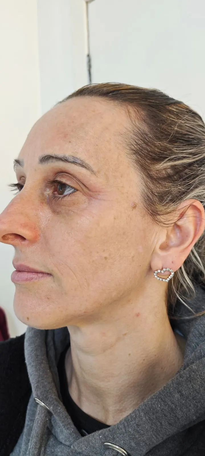 Peeling de alta performance